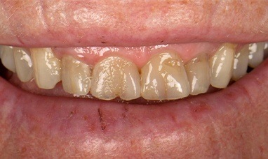 Discolored and short teeth before smile makeover