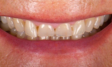 Short and worn down top teeth before dental restoration