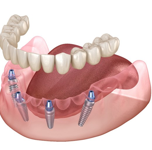 digital illustration of teeth in a day in Estero