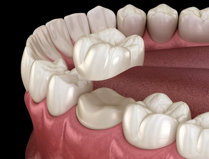 What’s the Best Material for a Dental Crown?